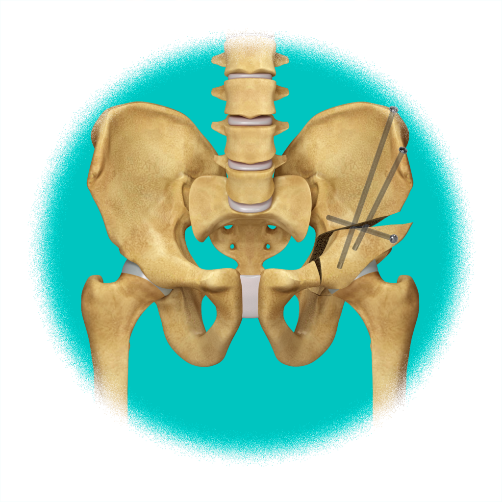 Osteotomia peri-acetabular, vista de frente
