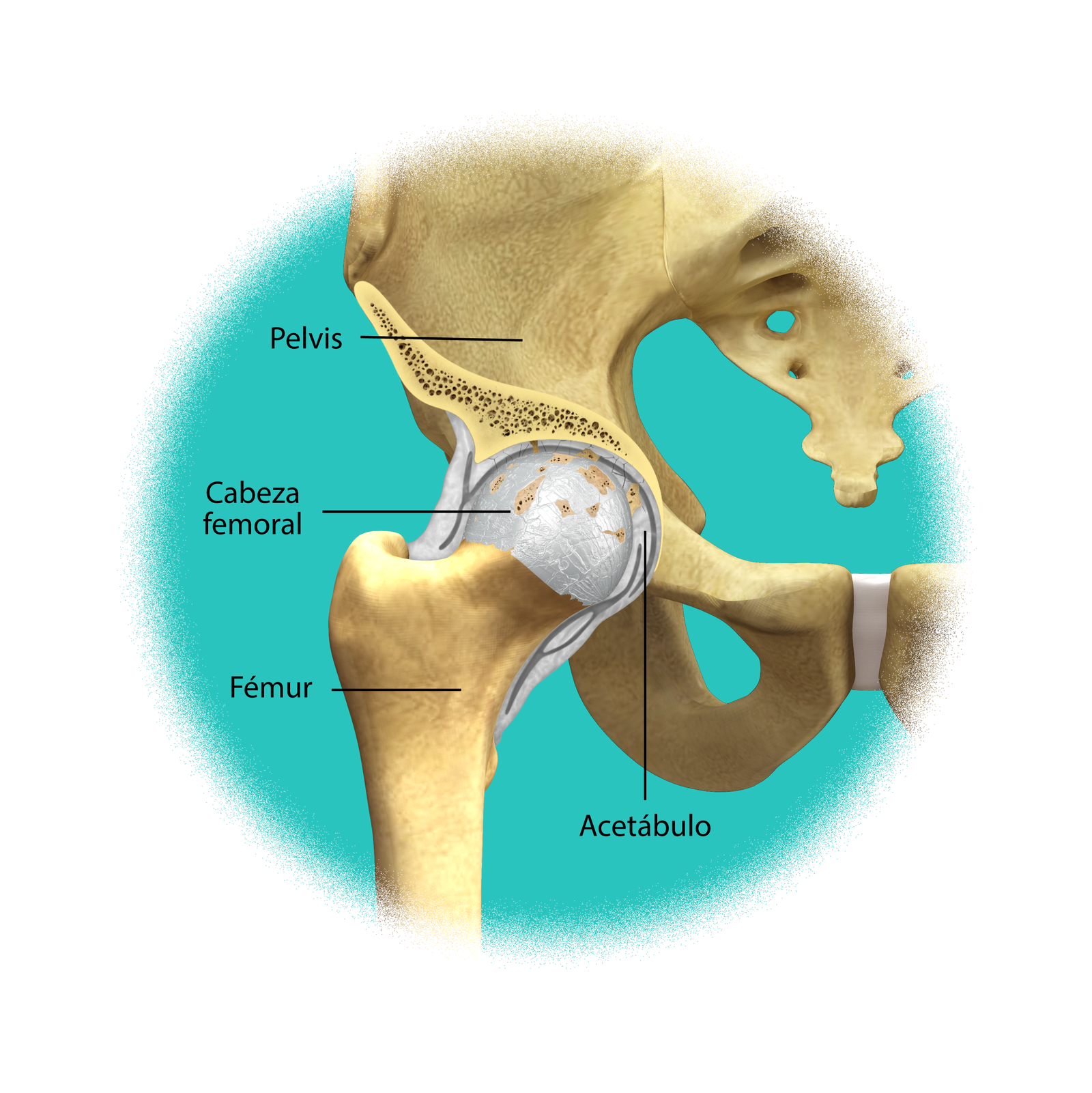 Artrósisi de la cadera